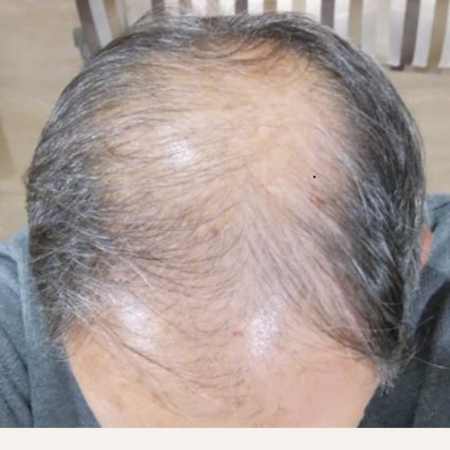Hair Transplant